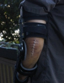 Prosthetic care and splint fabrication: Home health OT, Tampa, FL.