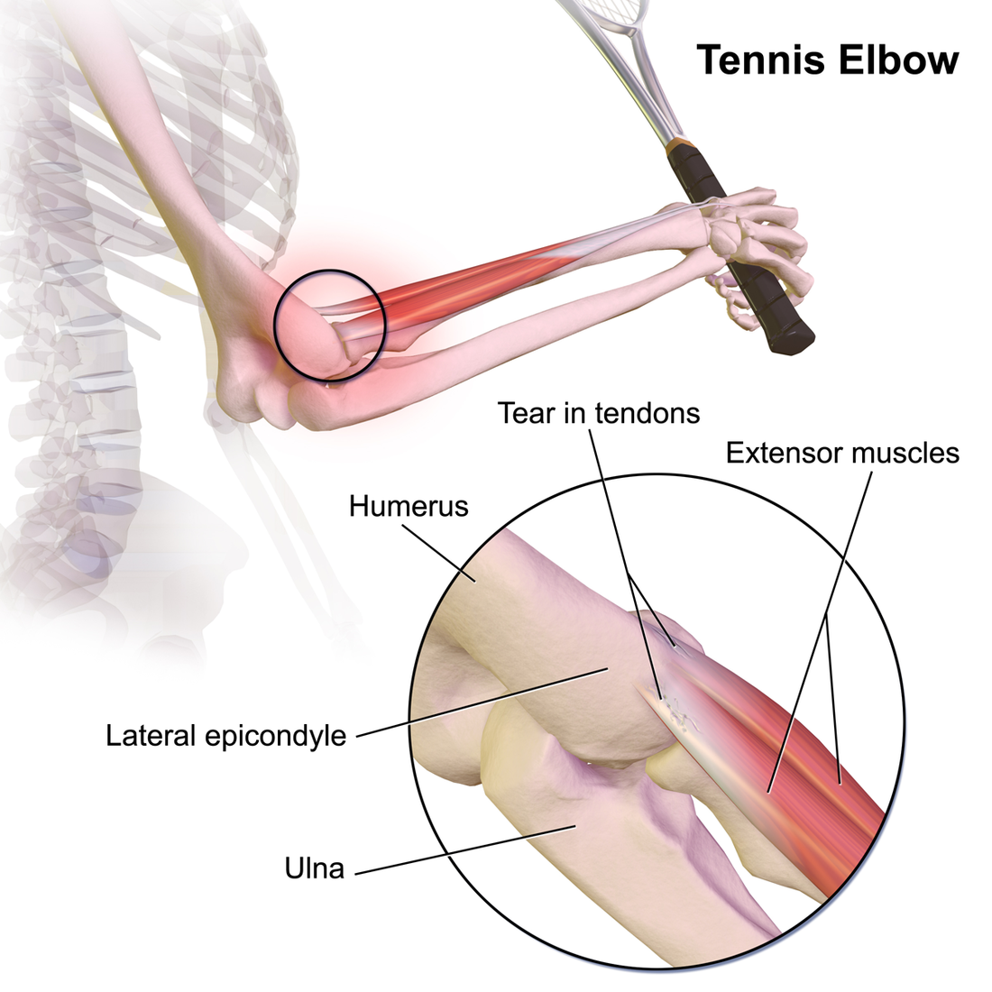 Lateral epicondylalgia (Tennis elbow)